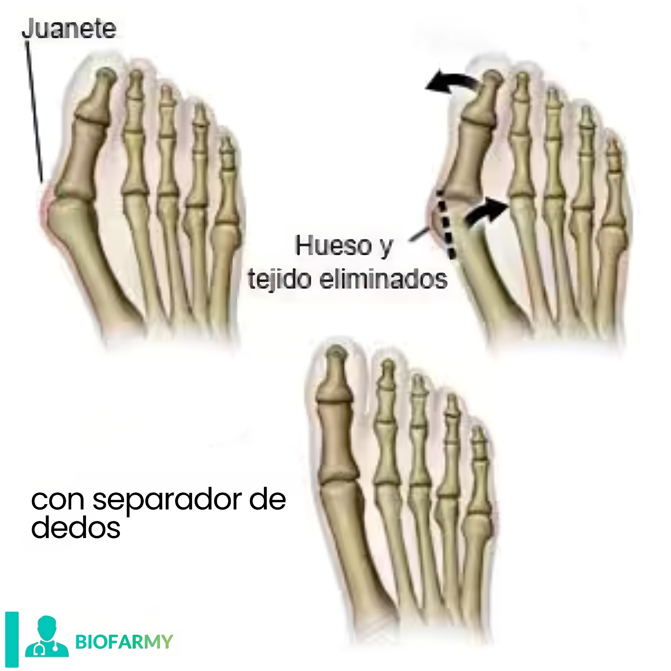 Separadores de dedos BioFarmy®